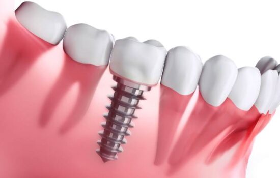 Dental-Implants