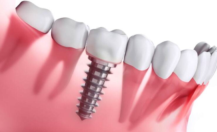Dental-Implants
