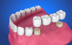 Dental Crown and Bridge image