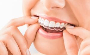 Clear aligners image