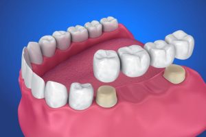 Dental Crown and Bridge image