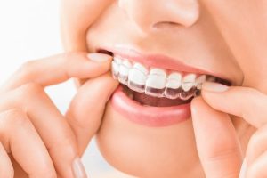 Clear aligners treatment in panchkula